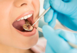 Проведение профессиональной гигиены одного зуба