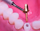 Зуб штифтовый литой из стали с пластмассовой фасеткой