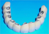 Зуб металлокерамический с керамическим плечем