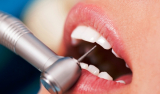 Снятие зубных отложений (с одного зуба)
